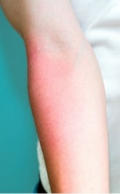 紫外線アレルギー